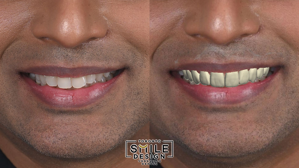 Revolutionizing Smiles with Cosmetic Dentist Solution to Crowded Teeth